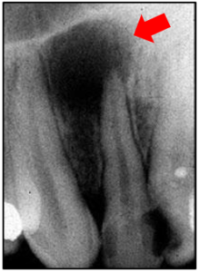 Fonte: https://endoavanzada.com/granuloma-apical-ental/radiografia_granuloma_apical_dental_endoavanzada/