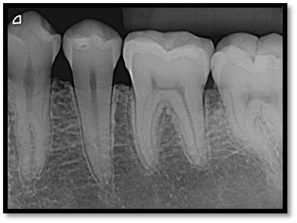 Relações maxila e mandíbula em dentados 